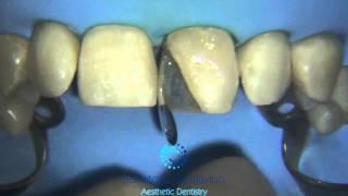 Direct Anterior Restorations