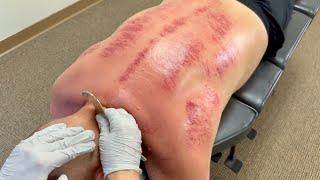 WORST SCAR TISSUE BUILD UP AFTER MULTIPLE CAR ACCIDENTS