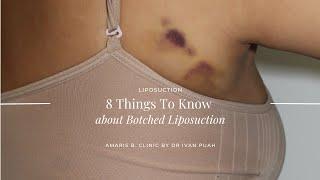 8 Things To Know About Botched Lipo | Amaris B. Clinic by Dr Ivan Puah