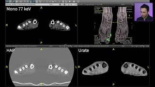 Spectral Imaging - Gout