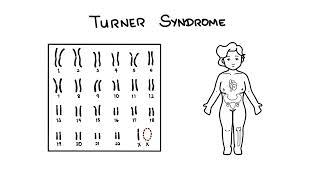 Turner Syndrome - 45,X Karyotype (Monosomy X)