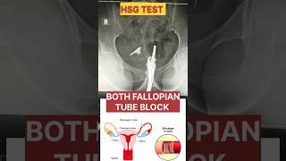 HSG TEST ( BOTH FALLOPIAN TUBE BLOCKED) #hsgtest #fallopiantubeblockage #radiology #xray