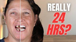 Can You Really Get Dental Implants in 24 Hours? My Story