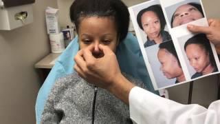 African American Female Rhinoplasty  - 6 Days Post-Op | Dr. Epstein