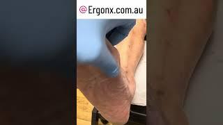Forefoot callus removal in podiatry clinic