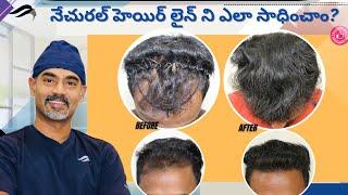 Hair Transplant In Hyderabad | Best Surgeon Results & Centre Of Hair Transplant Surgery In Hyderabad