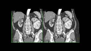 CT of the Acute Abdomen: GU Applications Part 1
