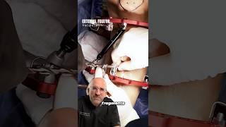 Surprising Waterproof Repair for Broken Bones⁉️