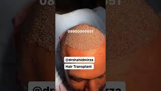 Full Dense Hair Transplant | FUE | #drshahidmirza #shorts #youtubeshorts #viral #trending #hair#reel