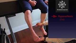NeuroExam: Variability in Babinski and Ankle Reflex in Stroke