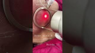 Co2  laser treatment for acne scar and pigmentation removal