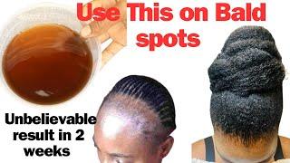 Your Edges May become Too Thick to Handle in JUST 2 WEEKS Of Use. How to Grow Your Hair Fast