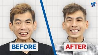 All on 4 Dental Implants in Vietnam Review: Why Aaron From Singapore Chose Hanoi!