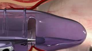 THD Surgery Video