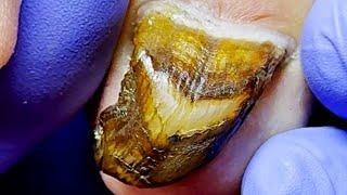 My Toenails Are Very Black, Like They Are Moldy, So I Trim Them Carefully~【Podiatry Clinic】