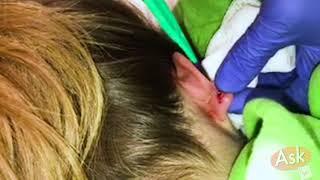 TabTV - Dr. Tabi performs a Foreign Body Removal of the Ear lobe