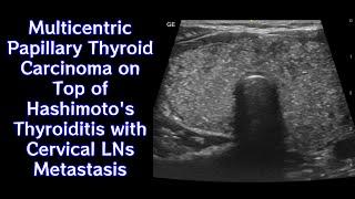 Multicentric Papillary Thyroid Carcinoma on Top of Hashimoto's Thyroiditis with Cervical LNs Mets