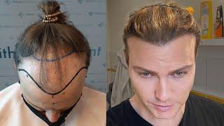 Hair Transplant in Timelapse - Before After Result