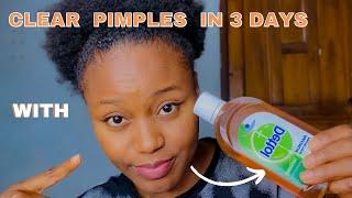 HOW TO USE DETTOL ANTISEPTIC LIQUID TO CLEAR ACNE| Get rid if acne in 3 days #dettol #clearskin