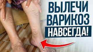 ИЗБАВЬСЯ от ВАРИКОЗА раз и НАВСЕГДА! / Первопричины и метод борьбы с расширением вен