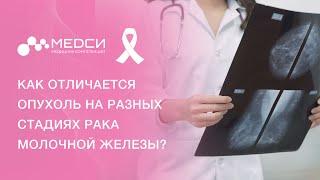 Стадии рака молочной железы // РМЖ 1,2,3,4 стадии #рмж #ракмолочнойжелезы #медси