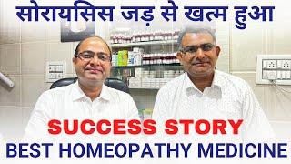 Psoriasis - Success Story | सोरायसिस को जड़ से खत्म किया