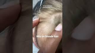 Nits on blonde hair #licetreatment #piojos #lice