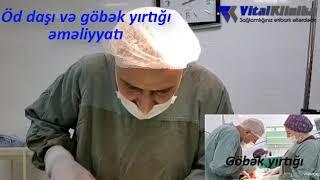 Vital Klinika. Öd daşı və Göbək yırtığı əməliyyatları eyni zamanda.