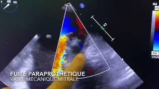 Fermeture percutanée de fuite paraprothetique