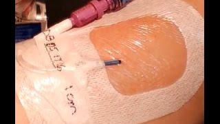 PICC Dressing Change: Tegaderm™ I.V. Advanced