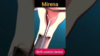 Mirena#birthcontroldevice #contraceptives #IUD