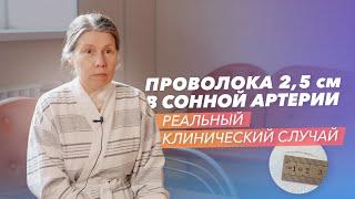 Хирургическое удаление инородного тела из левой общей сонной артерии. Отзыв пациента: Ольга