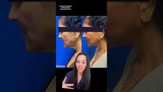There are many different types of facelifts marketed by surgeons, my personal preference is the deep