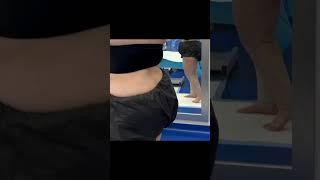 Lipedema Leg Transformation | 360° Cankle & Knee Liposuction by Dr. Thomas Su at Artlipo | Tampa, FL