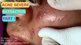 Nặn mụn nhọt ẩn vùng mặt siêu nhiều|Squeeze big pimples, hidden acnes part 1 Dr Hoan 0985773391