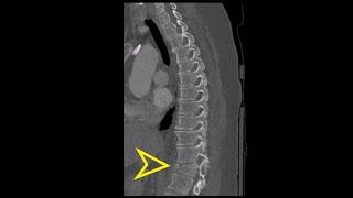 Thoracic Spine CT: Chance Fracture of T12