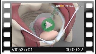 DynaMesh®-PRP - Animation: Hysteropectopexy - Posterior Fixation