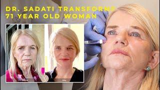 Dr. Sadati Transforms 71 year old Woman with Lower Face and Neck Lift and Restylane Lyft Filler