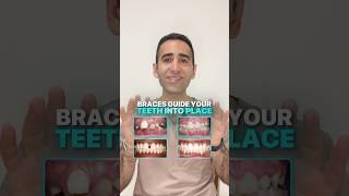 How braces work and are able to straighten your teeth  #braces #orthodontist