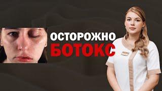 ОСЛОЖНЕНИЯ ПОСЛЕ БОТОКСА, ДИСПОРТ, КСЕОМИН ‼️ ПТОЗ ВЕК, ОПУЩЕНИЕ БРОВЕЙ 