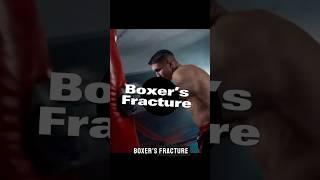 Boxer’s Fractures: What you need to know  #shorts
