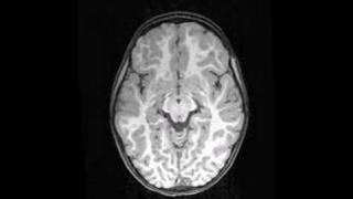 OC top to bottom brain MRI