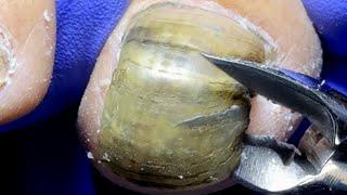 Most Of The Black Toenails Were Cut Off In An Instant!【Dr. Liu's Pedicur】