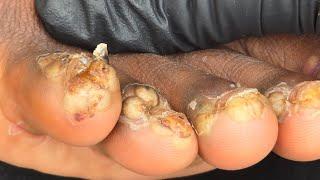 Rehema Teye's big clear jiggers #1 -- watch long videos @riseupsociety.net & @ruskenya.org