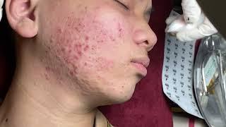 Make your Acne Treatment Huong Da Nang#501 | acne 2022 PArt 2