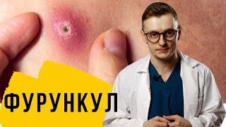 Фурункул.  Карбункул.  Фурункульоз. Що робити? Методи лікування.