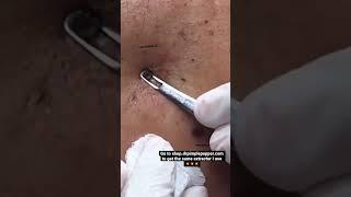 Satisfying Blackhead Extractions w/ Dr. Pimple Popper!  #shorts