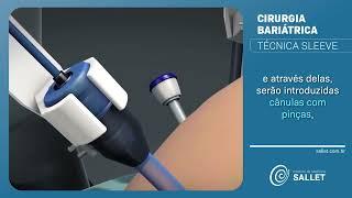 Técnica Sleeve | Cirurgia Bariátrica 3D