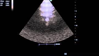 A lines in lung U/S