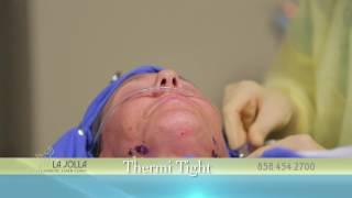 ThermiTight Procedure - La Jolla Cosmetic Laser Clinic